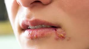 This Simple Trick About Causes and Risk Factors of Herpes Changes Everything